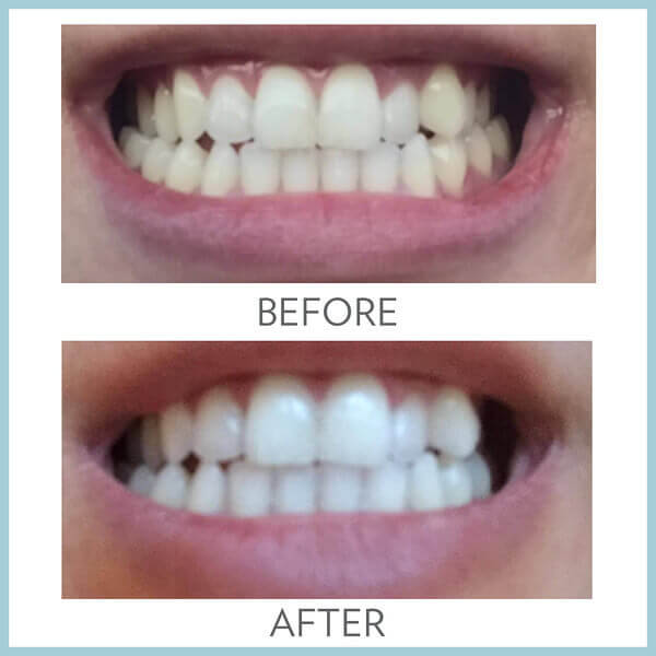 AP-24-Whitening-Fluoride-Toothpaste-Before-and-After-Picture-1