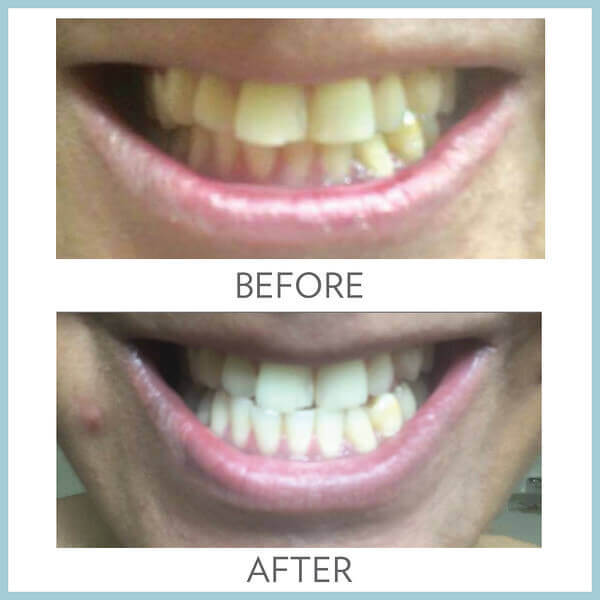 AP-24-Whitening-Fluoride-Toothpaste-Before-and-After-Picture-2