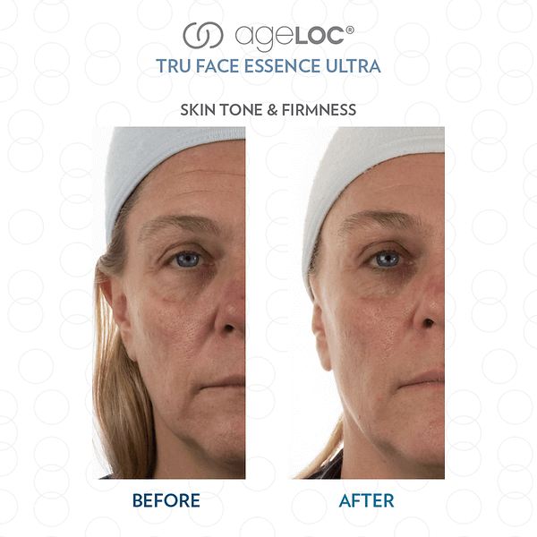 Nu-Skin-ageLOC-Tru-Face-Essence-Ultra-Before-and-After-Picture